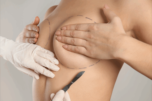 FROM SURGERY TO SOCIAL IN A WEEK: RISE OF RAPID RECOVERY BREAST AUGMENTATION
