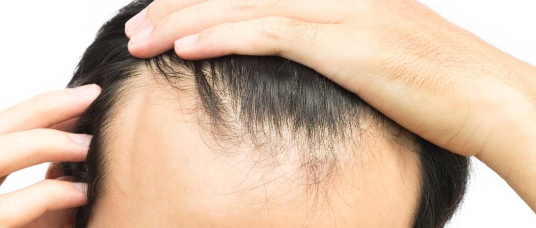 HEALTHY HABITS, BETTER HAIR: HOW LIFESTYLE CHOICES IMPACT HAIR RESTORATION