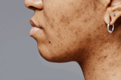 HEALING HYPERPIGMENTATION AFTER WINTER DERMATITIS