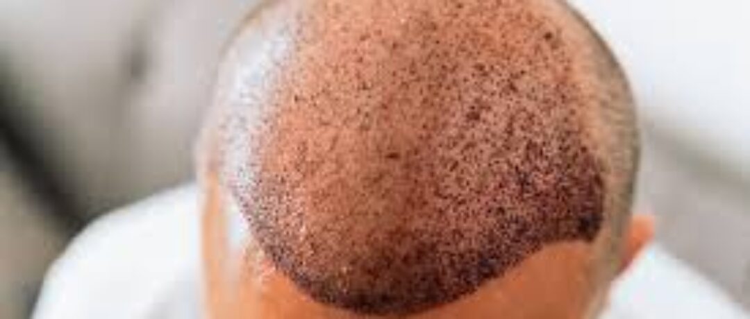 THINKING ABOUT A HAIR TRANSPLANT IN 2026? READ THIS FIRST