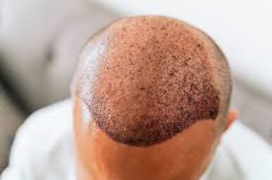 THINKING ABOUT A HAIR TRANSPLANT IN 2026? READ THIS FIRST